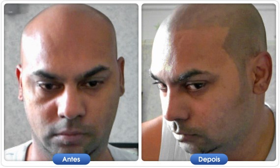 Antes e depois DermMatch em homem com cabeça rapada e calvície
