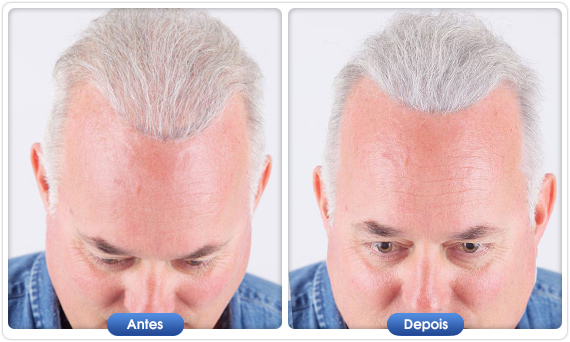 Antes e depois DermMatch em homem com cabelo branco e linha frontal