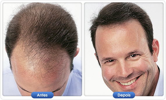 Antes e depois DermMatch em homem com cabelo ralo na zona frontal e couro cabeludo visível