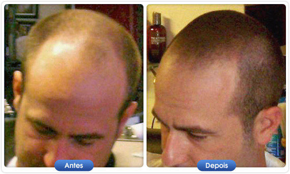Antes e depois DermMatch em homem com calvície avançada e cabelo curto