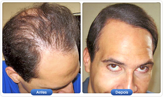 Antes e depois DermMatch em homem com calvície frontal e entradas