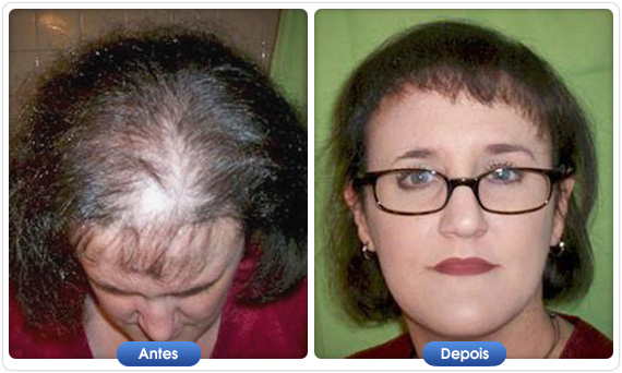 Antes e depois DermMatch em mulher com alopecia e couro cabeludo visível