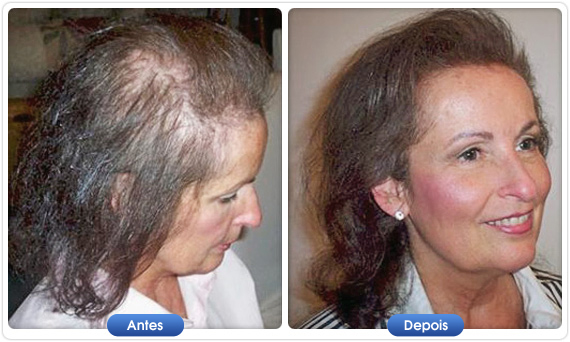 Antes e depois DermMatch em mulher com cabelo fino e pouca densidade capilar