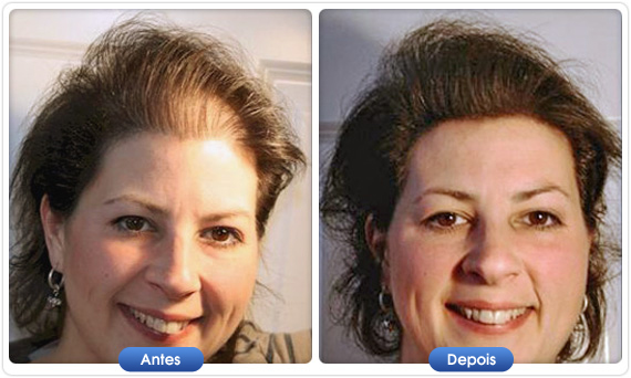 Antes e depois DermMatch em mulher com entradas e linha frontal visível