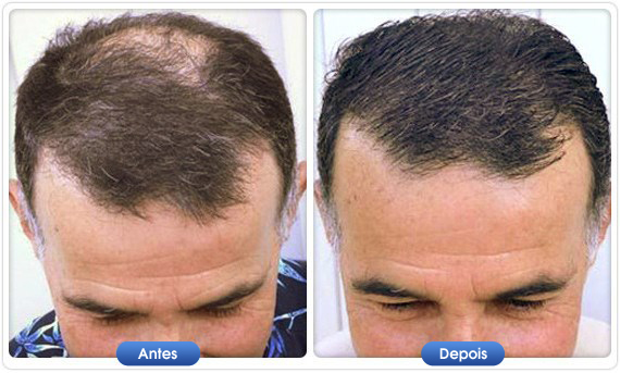 Antes e depois DermMatch em homem com cabelo fino e zonas de pouca densidade