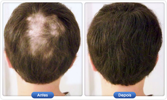 Antes e depois DermMatch em cabelo ralo na coroa