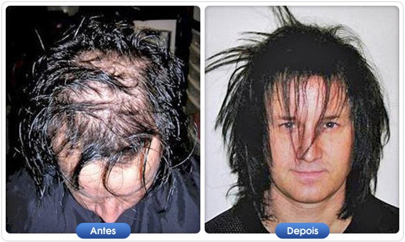 Antes e depois DermMatch em homem com queda de cabelo avançada
